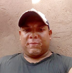 José Erick Brito Zarate, herido que recibe atención médica en clínica del sur de La Guajira.